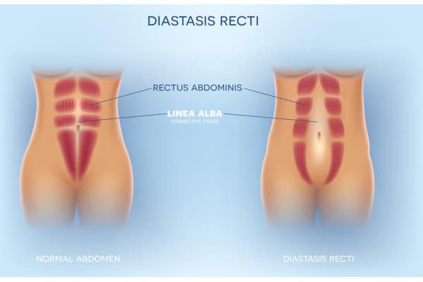 What Non-Surgical Options Are Available for Diastasis Recti Gosport?