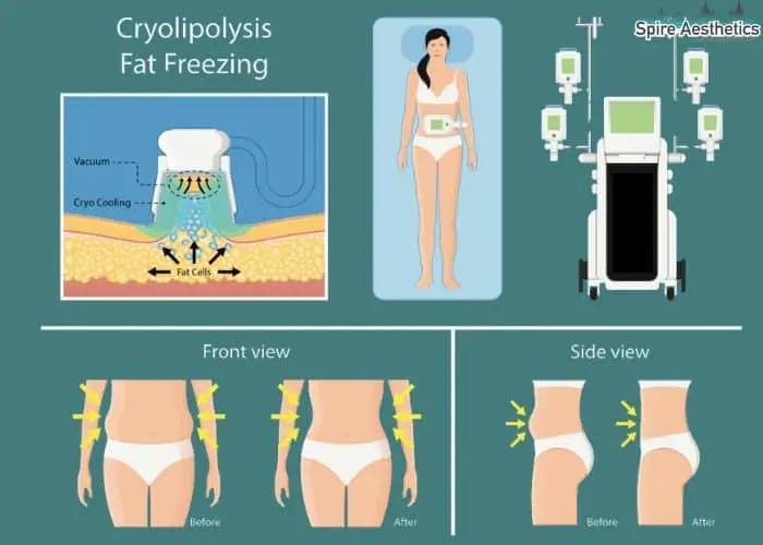 Fat freezing treatment Gosport benefits for competitions to remove stubborn fat deposits.