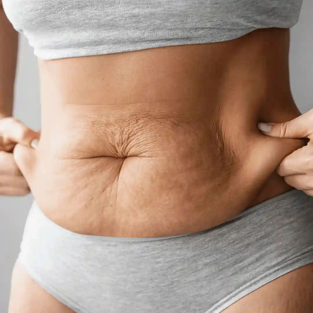 Is It Normal to Have Loose Skin After Pregnancy Gosport?