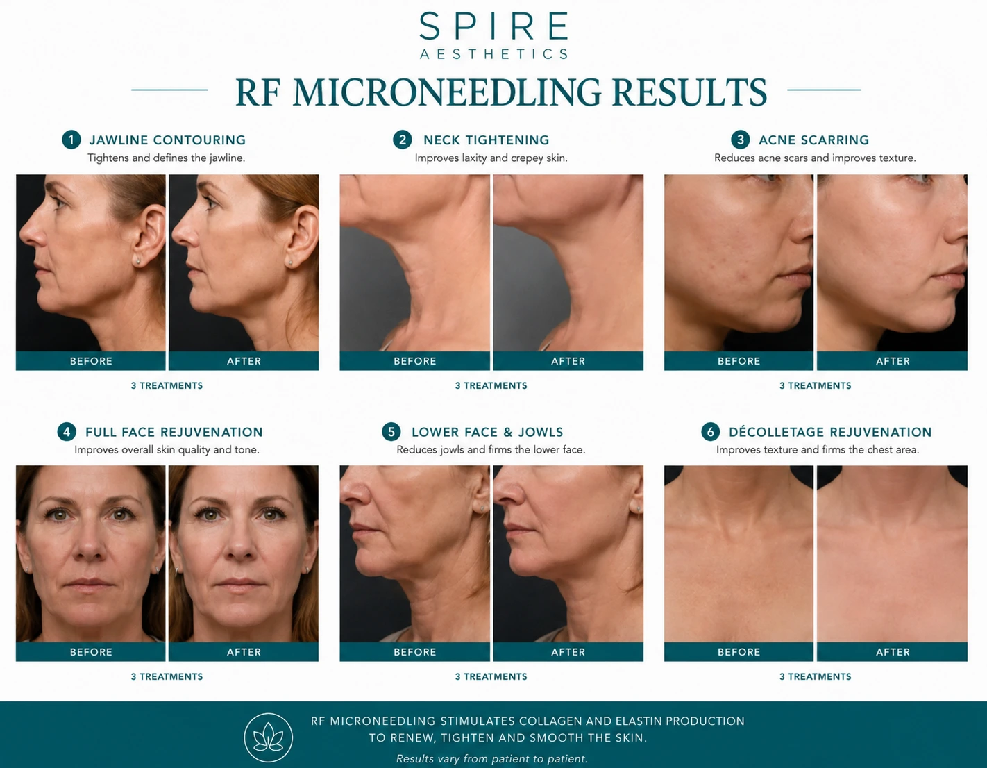 RF Microneedling Skin tightening Gosport results