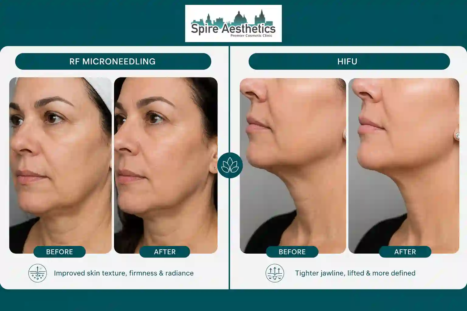 Can RF Microneedling and HIFU Be Combined Gosport?