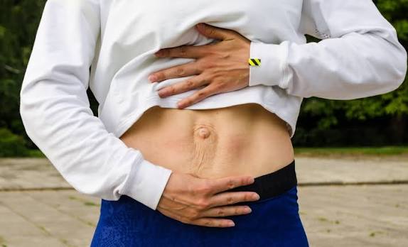 When Could Diastasis Recti Be the Missing Piece of the Puzzle Gosport?