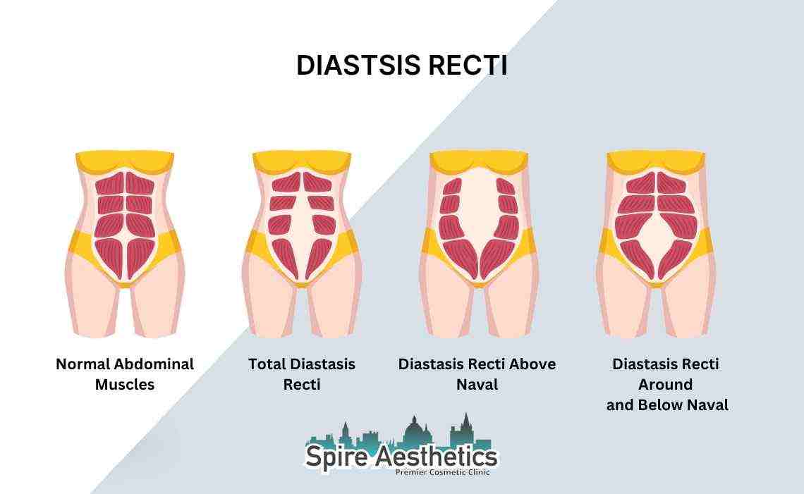 Is Non-Surgical Diastasis Recti Treatment Right for You? Common Concerns Answered Gosport